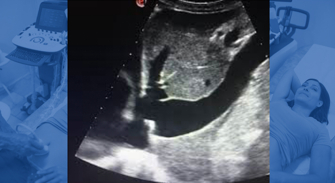 VCI y estado hemodinámico